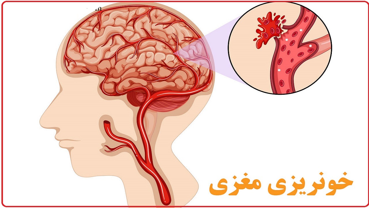 شناسایی علت‌های خونریزی مغزی و پارگی عروق در مغز