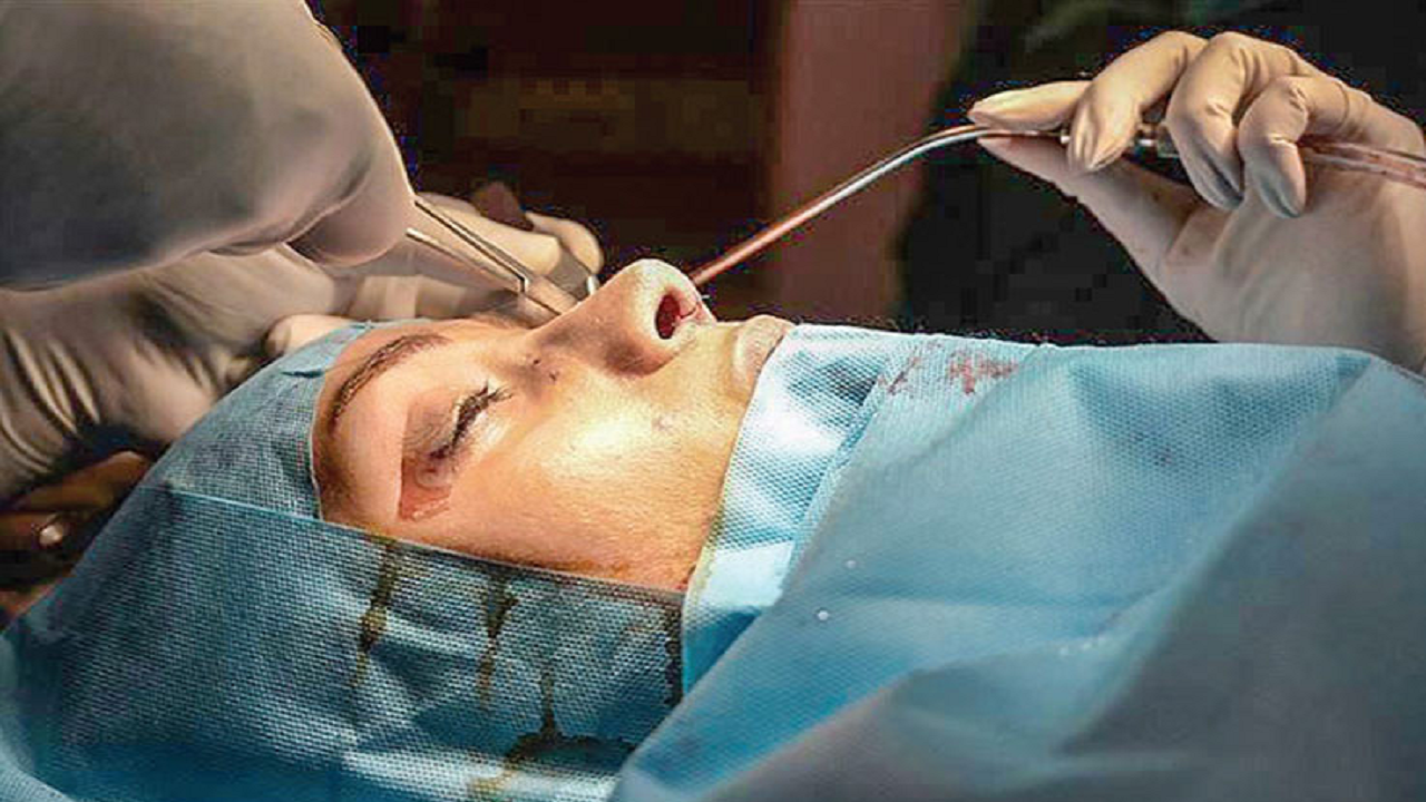 سن جراحی زیبایی به نوجوانی رسید
