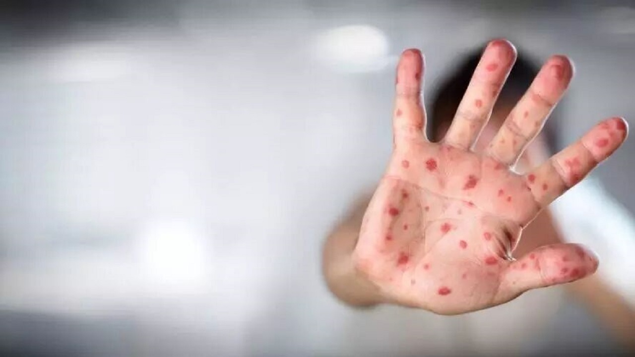 یک هفته قرنطینه خانگی برای مبتلایان به آبله مرغان الزامی است