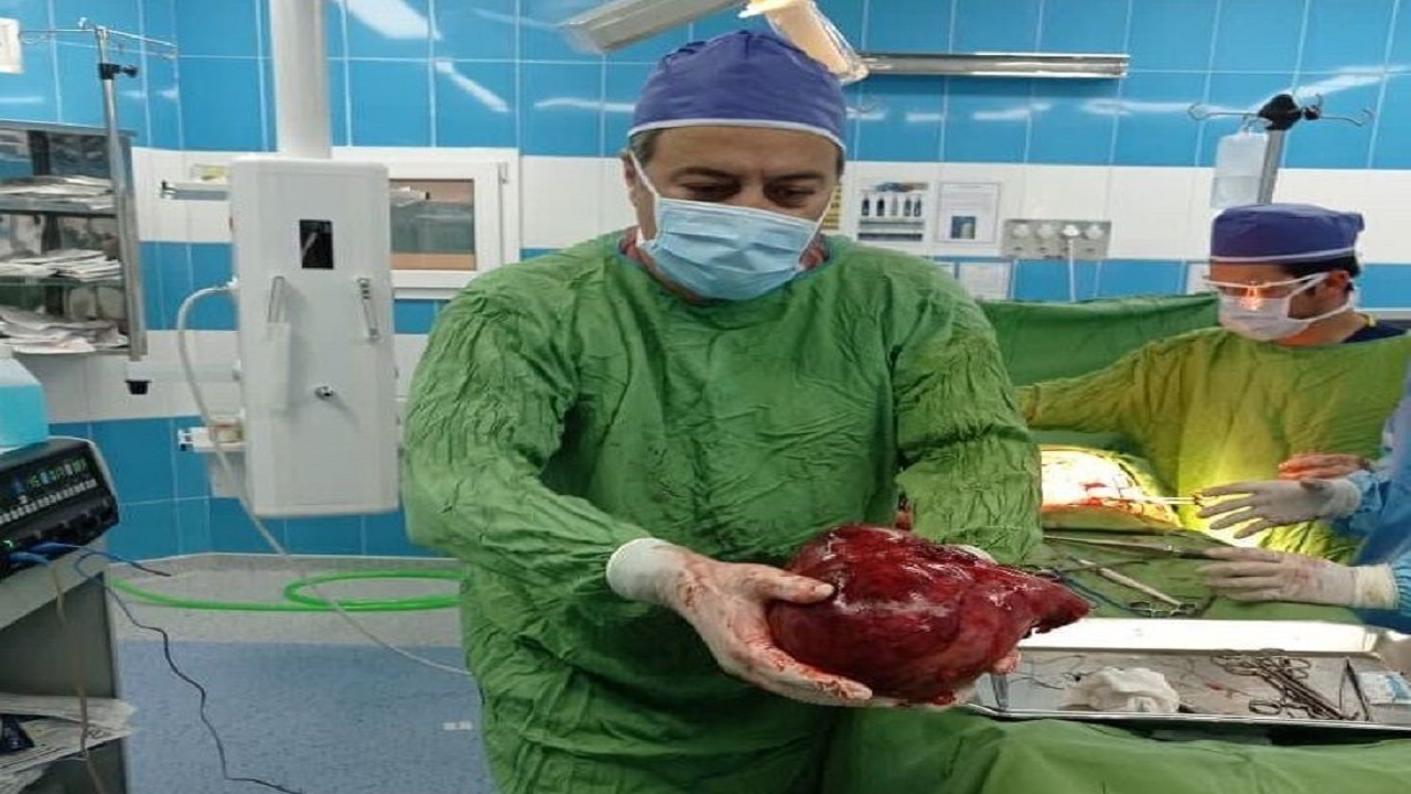 توده سه و نیم کیلویی از کلیه یک بیمار در تربت‌حیدریه خارج شد