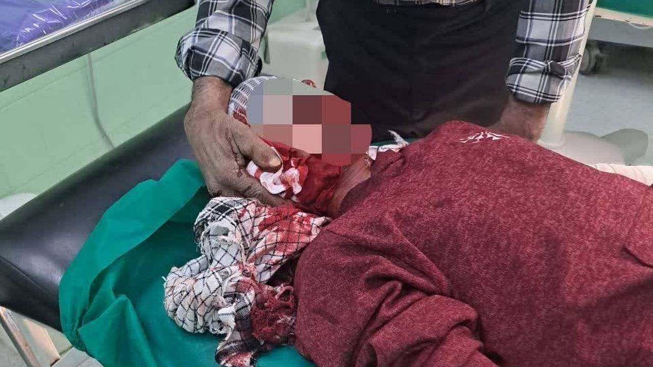 مصدومیت نوجوان راوری در چهارشنبه سوری