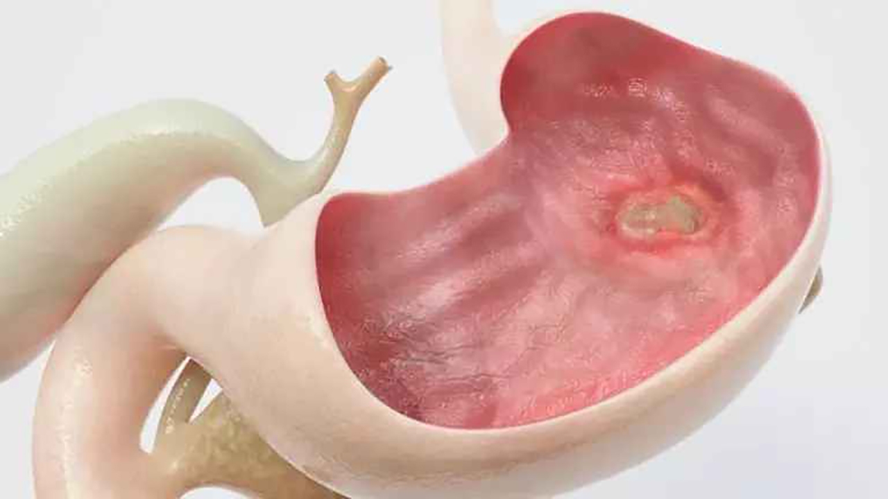 آیا تشخیص زخم معده تنها با آزمایش ممکن است؟ + فیلم