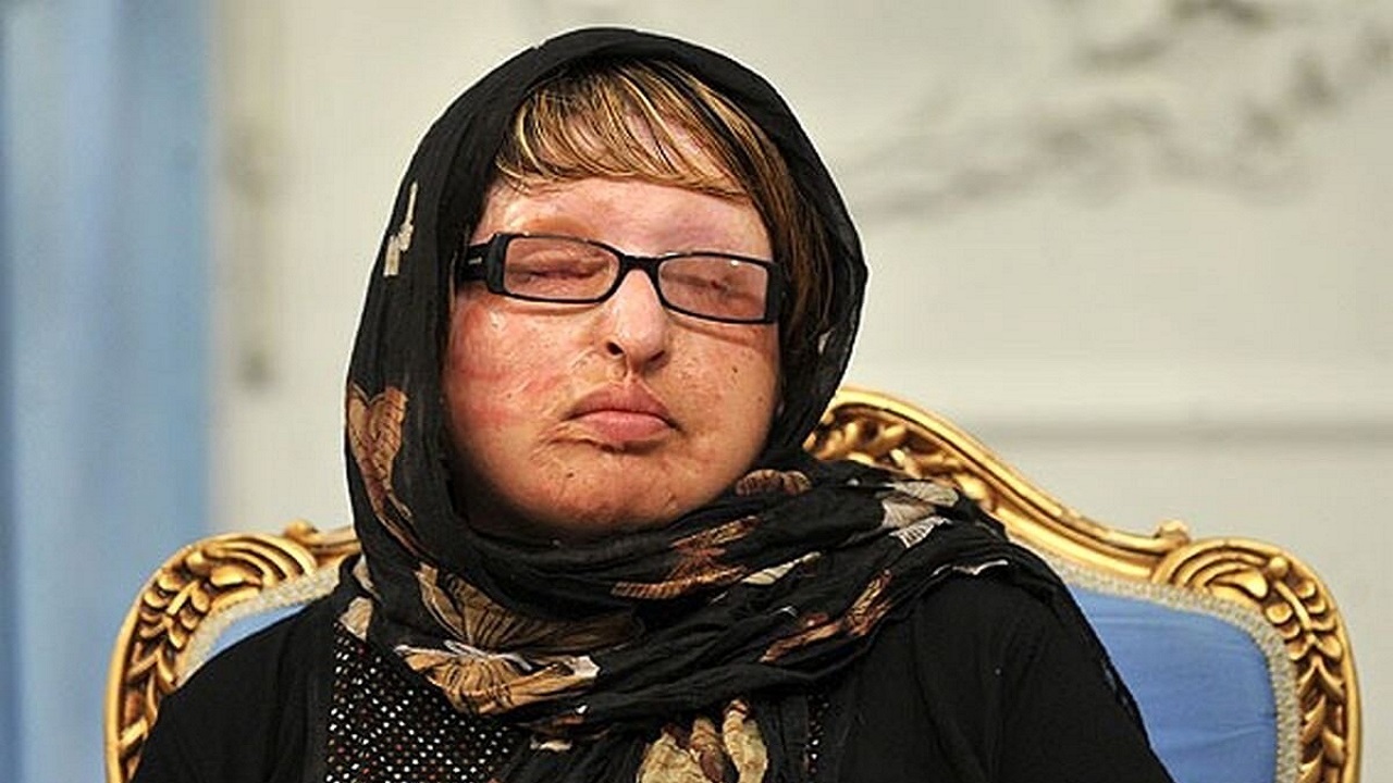 آمنه بهرامی در اسیدپاشی خواستگارش نابینا شد