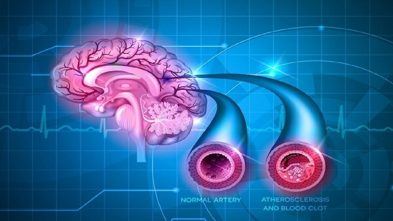 آیا استاتین در کاهش ریسک سکته در مبتلایان به فیبریلاسیون دهلیزی مؤثر است؟