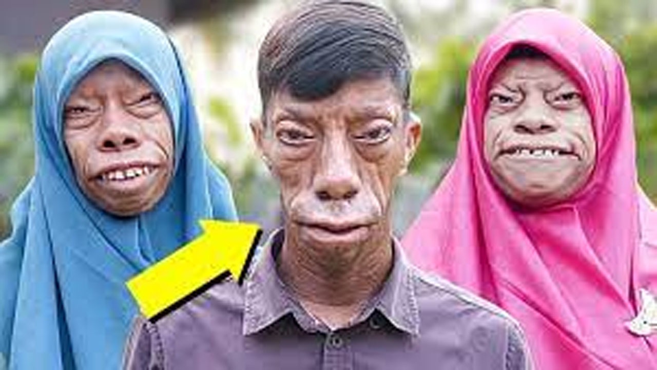 وضعیت عجیب خانواده‌ای که درگیر یک بیماری نادرند + عکس