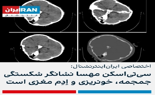 سی تی اسکن
