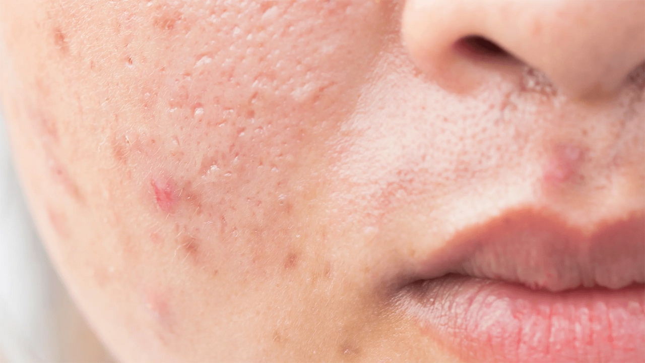 راهکار خانگی رفع جای جوش صورت + فیلم