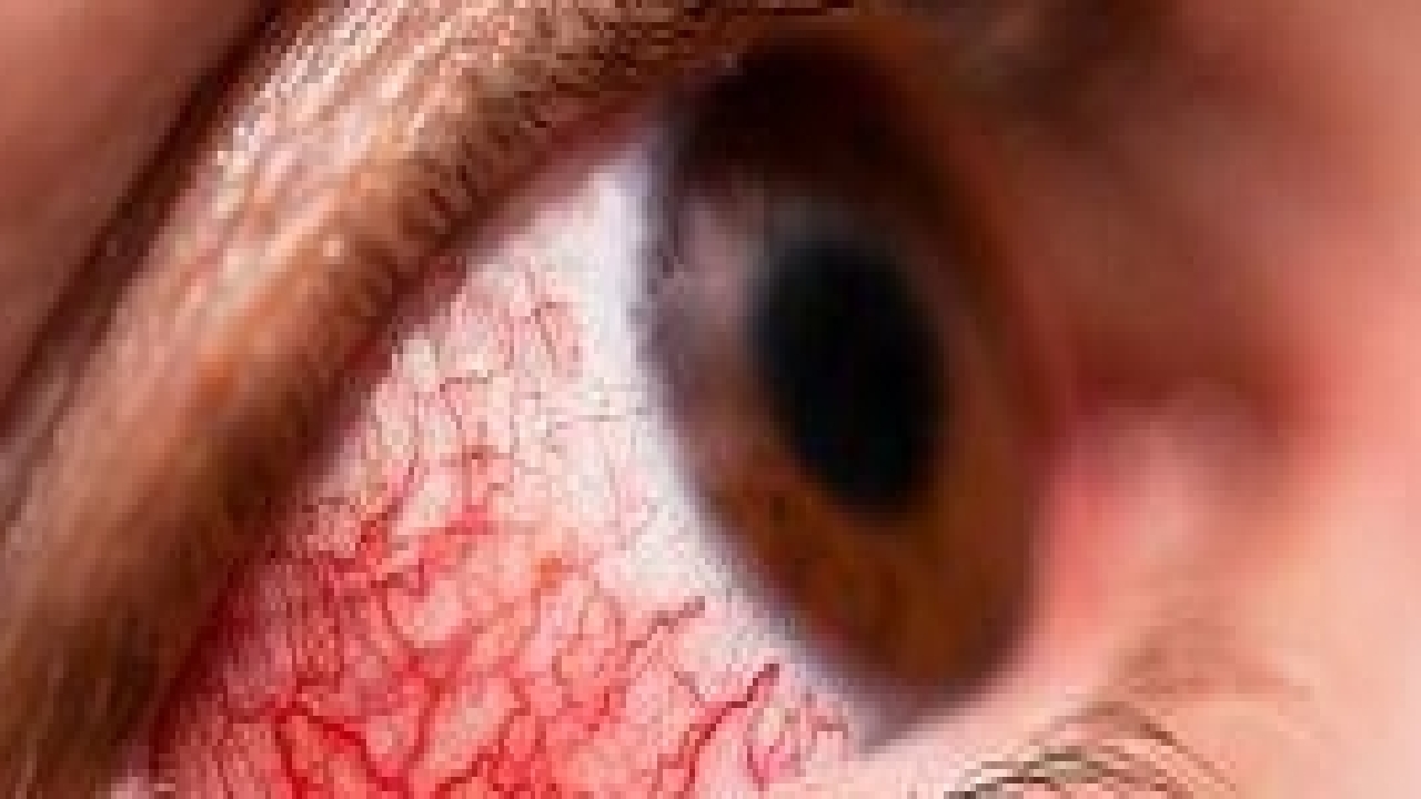 خارج کردن لارو مگس از چشم یک کودک + فیلم