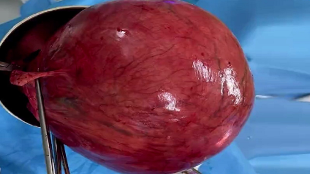 خارج کردن توده ۴ کیلوگرمی از شکم زن ۵۸ ساله بابلی