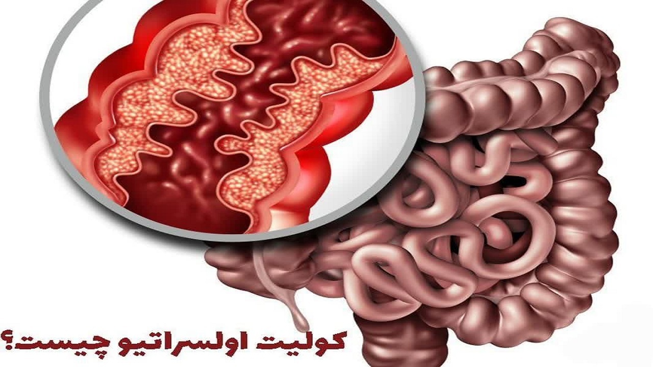 افزایش شیوع بیماری کولیت اولسروز در بین جوانان