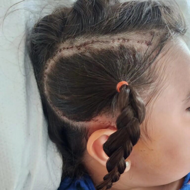عمل جراحی مغز دختر ۶ ساله