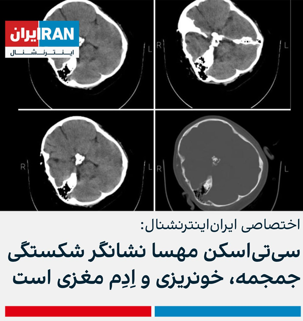 دروغ اینترنشنال درباره علت فوت مهسا امینی دروغ اینترنشنال درباره علت فوت مهسا امینی