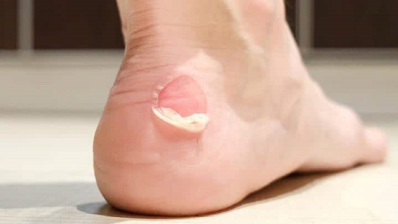 چرا نباید تاول‌های روی زخم را از بین ببرید؟ + فیلم