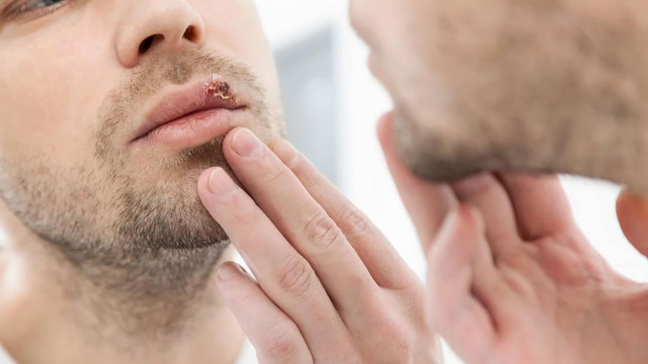 علت و درمان تبخال در طب سنتی