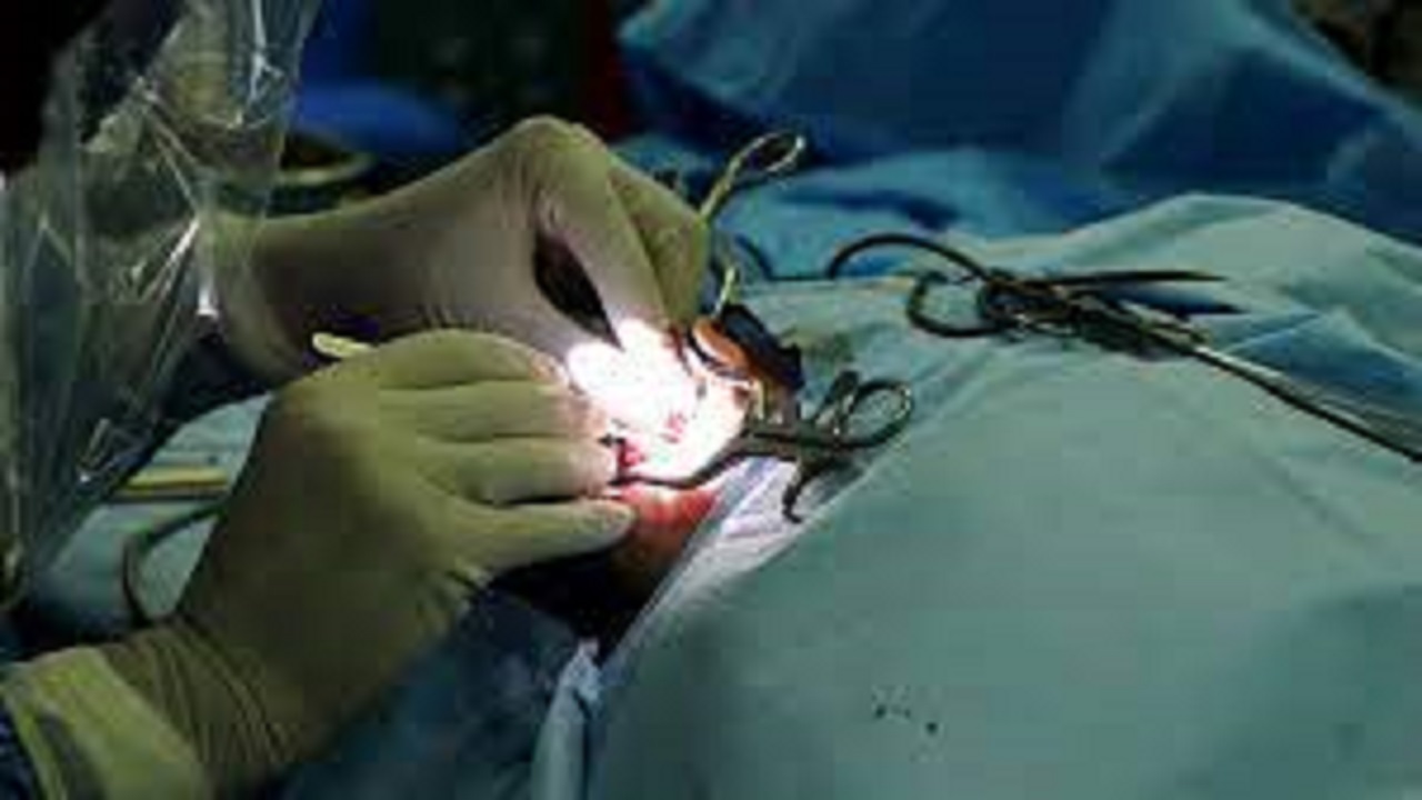 خدمات کاشت حلزون شنوایی زیرپوشش بیمه سلامت قرار گرفت