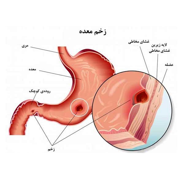 زخم معده