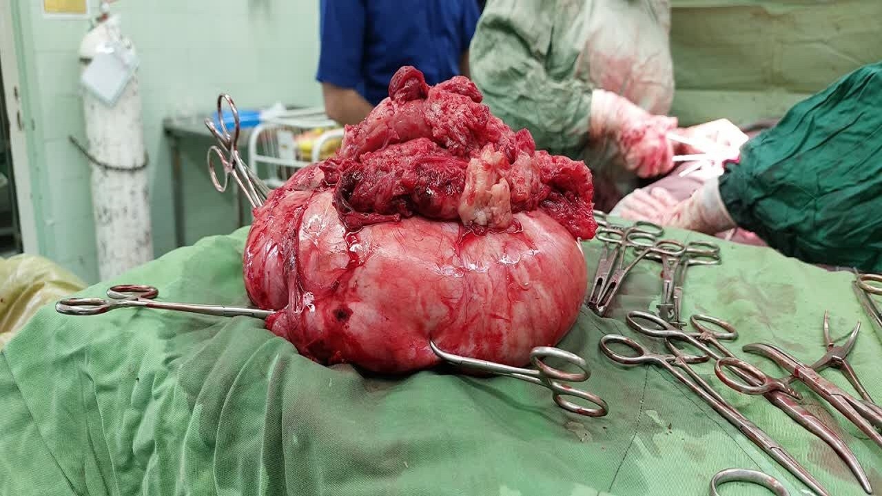 خارج کردن توده ۲.۵ کیلوگرمی از بدن یک خانم کبودرآهنگی