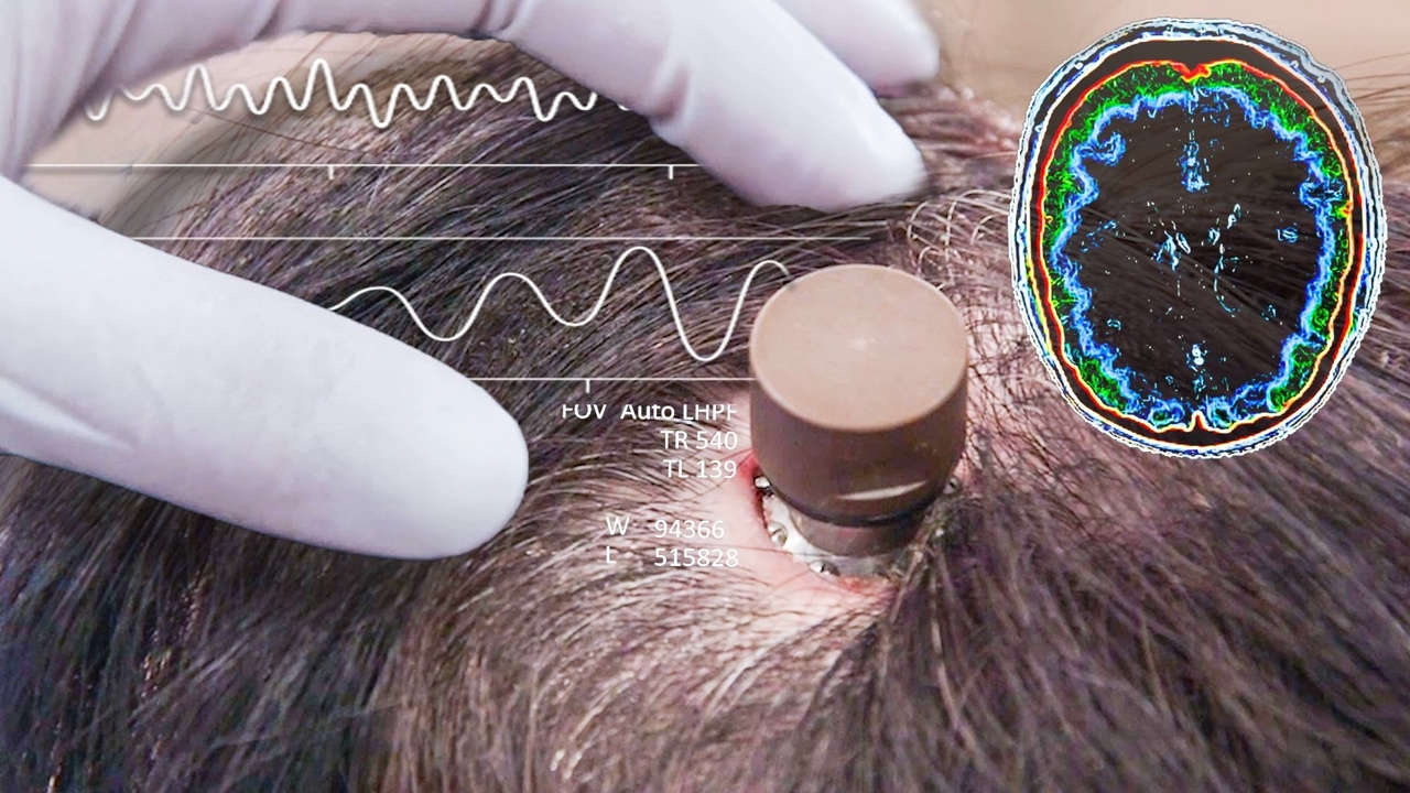 هدایت رایانه توسط ذهن با کاشت Neuralink در مغز + فیلم