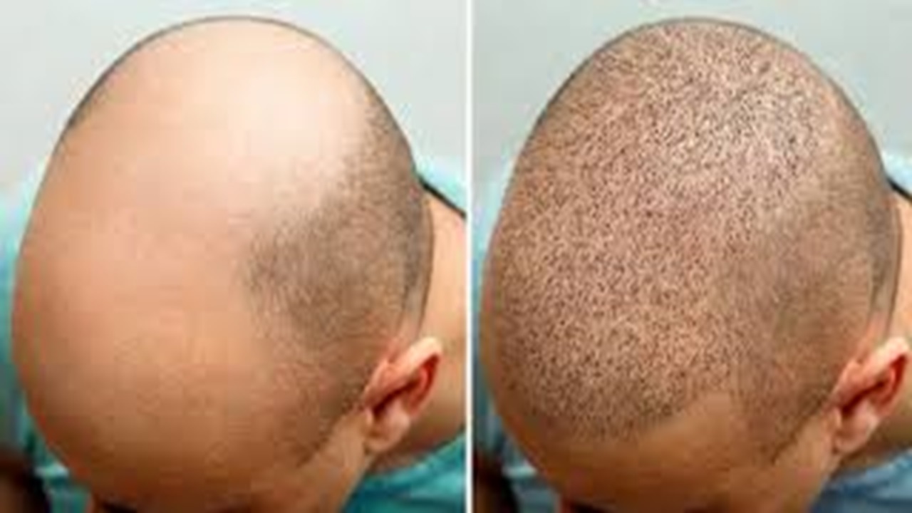 شرایط کاشت مو چیست؟