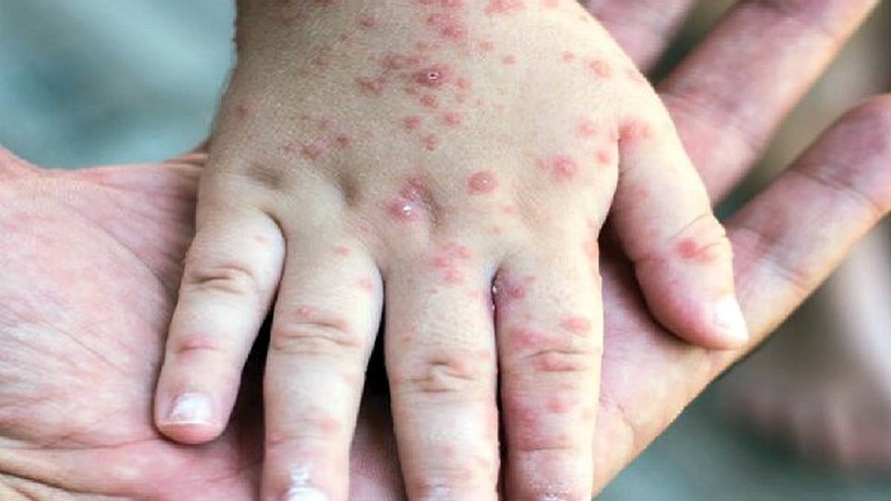 بررسی وضعیت بیماری سرخک در دانشگاه علوم پزشکی