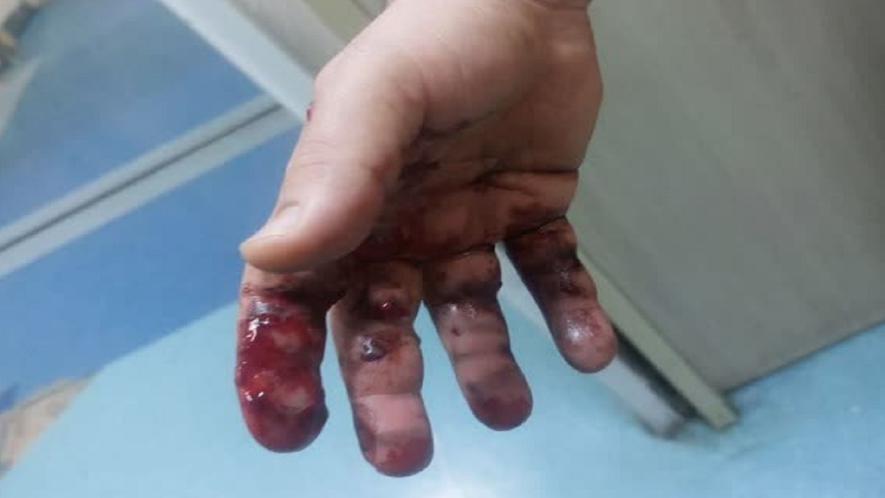 ۵۷ نفر در حادثه چهارشنبه آخر سال قم مصدوم شدند /
 از قطع انگشت تا سوختگی شدید