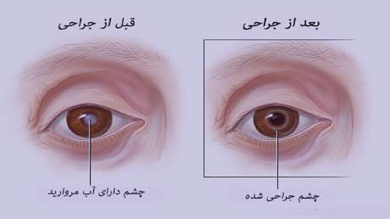 آب مروارید چیست؟ فیلم