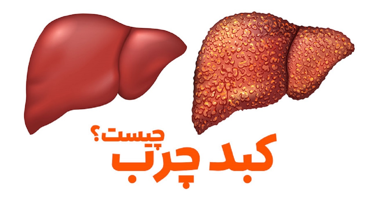 کبد چرب در زنان + فیلم