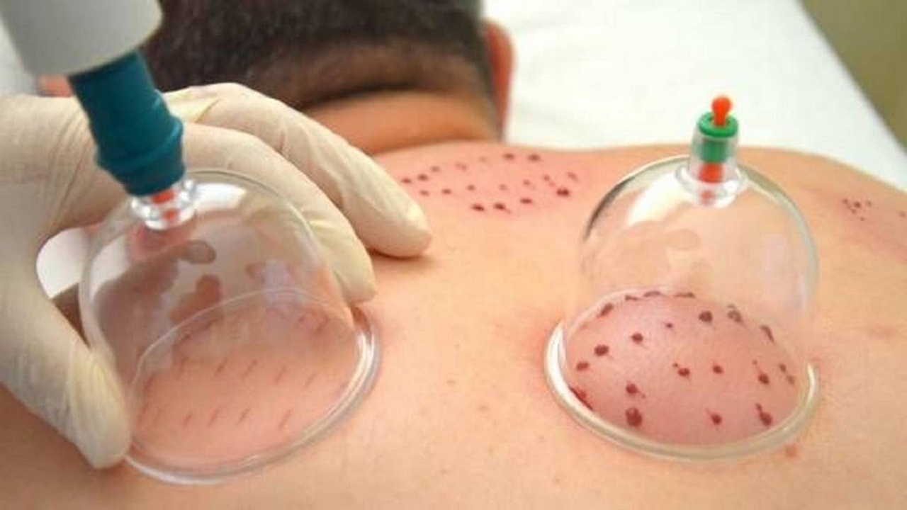 بهترین جای حجامت برای بدن کجا است؟ + فیلم
