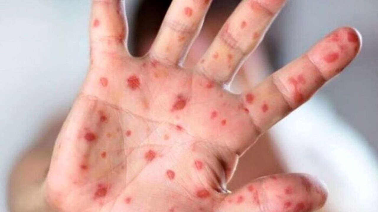 افزایش موارد ابتلا به سرخک در افغانستان