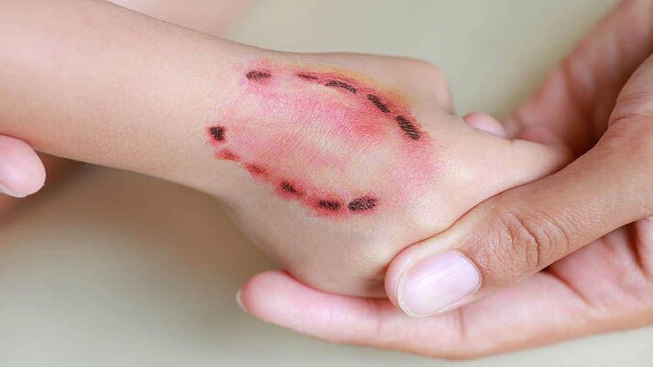 با گازگرفتگی توسط حیوانات چه باید کرد؟