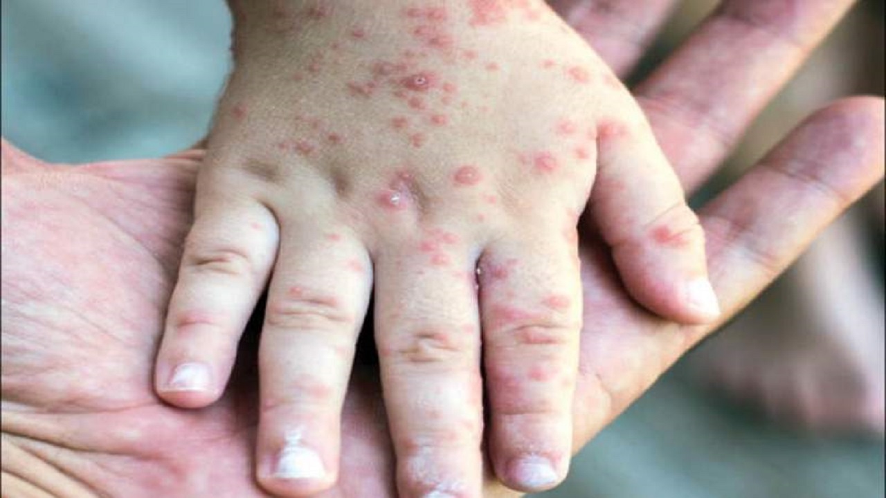 زنگ خطرافزایش ابتلا به سرخک در منطقه سیستان