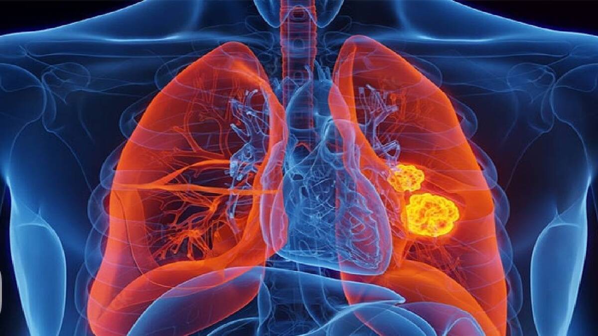 باشگاه خبرنگاران -تاثیر رژیم غذایی کم‌چرب برای کاهش خطر ابتلا به سرطان ریه
