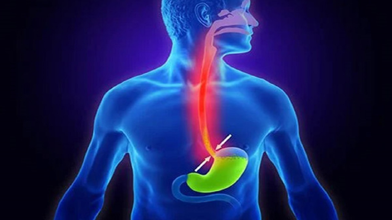 علائم رفلاکس معده چیست؟ + فیلم