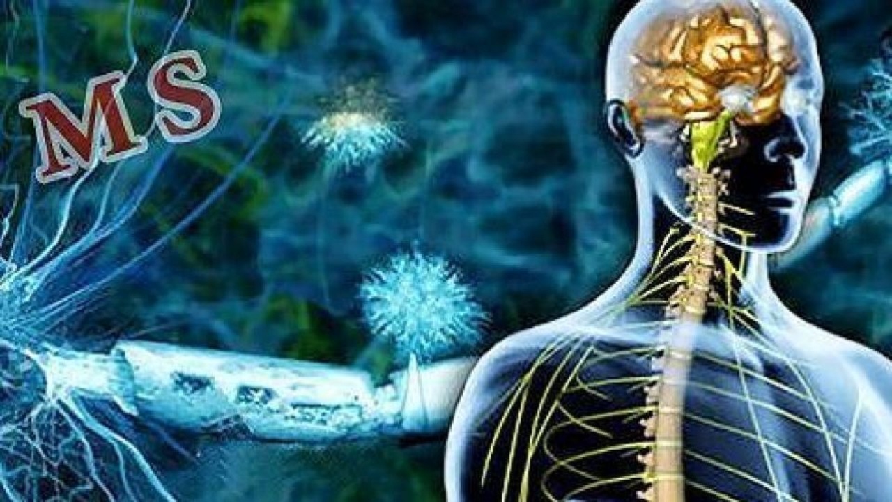 بیش از ۳۱۵ نفر در شاهرود به بیماری ام‌اس مبتلا هستند