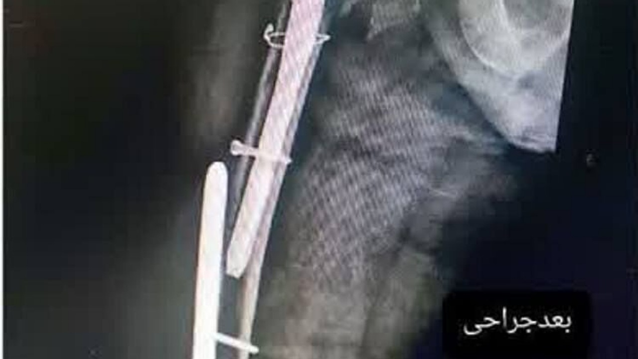 انجام موفق نخستین جراحی استخوان در جوین خراسان رضوی