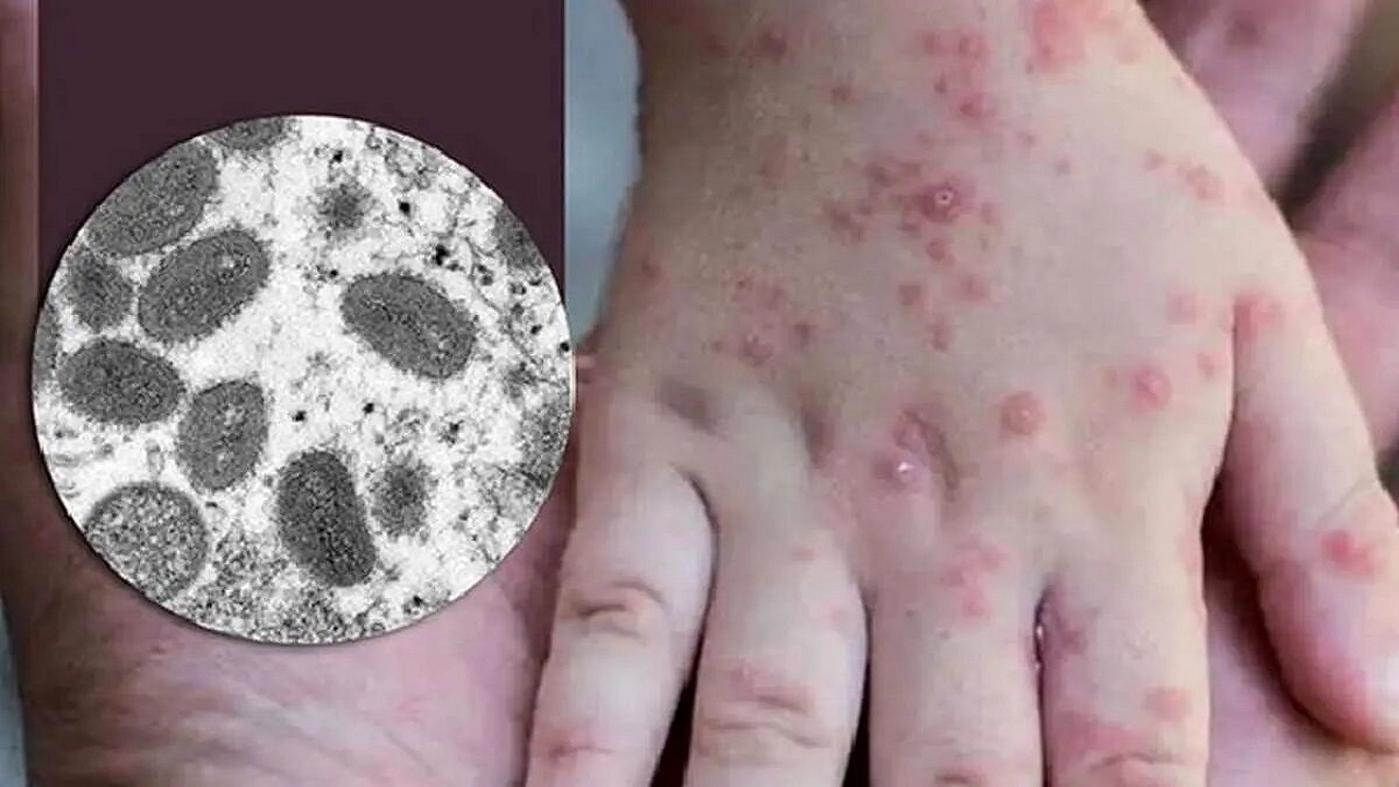 موردی از آبله میمونی در استان گزارش نشده است