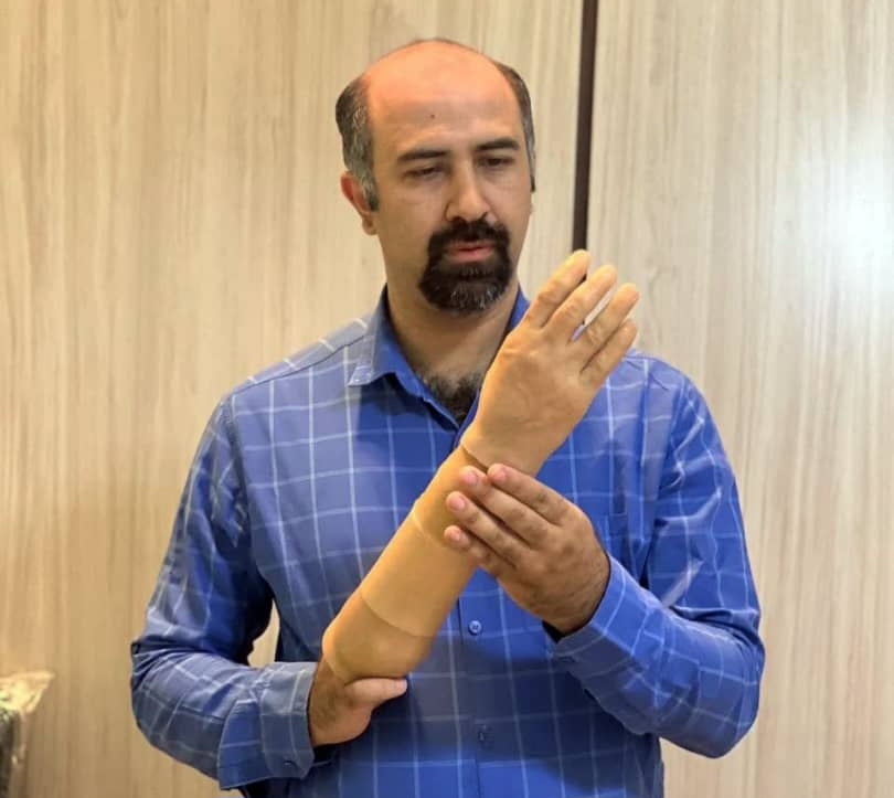 ساخت دست قابل حرکت در ایران