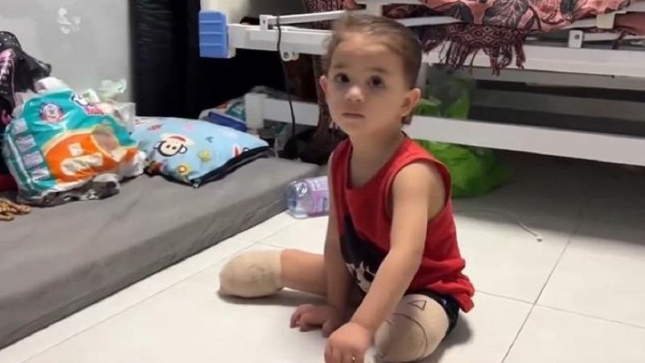 ۴ هزار و ۵۰ عمل قطع عضو در غزه انجام شده است