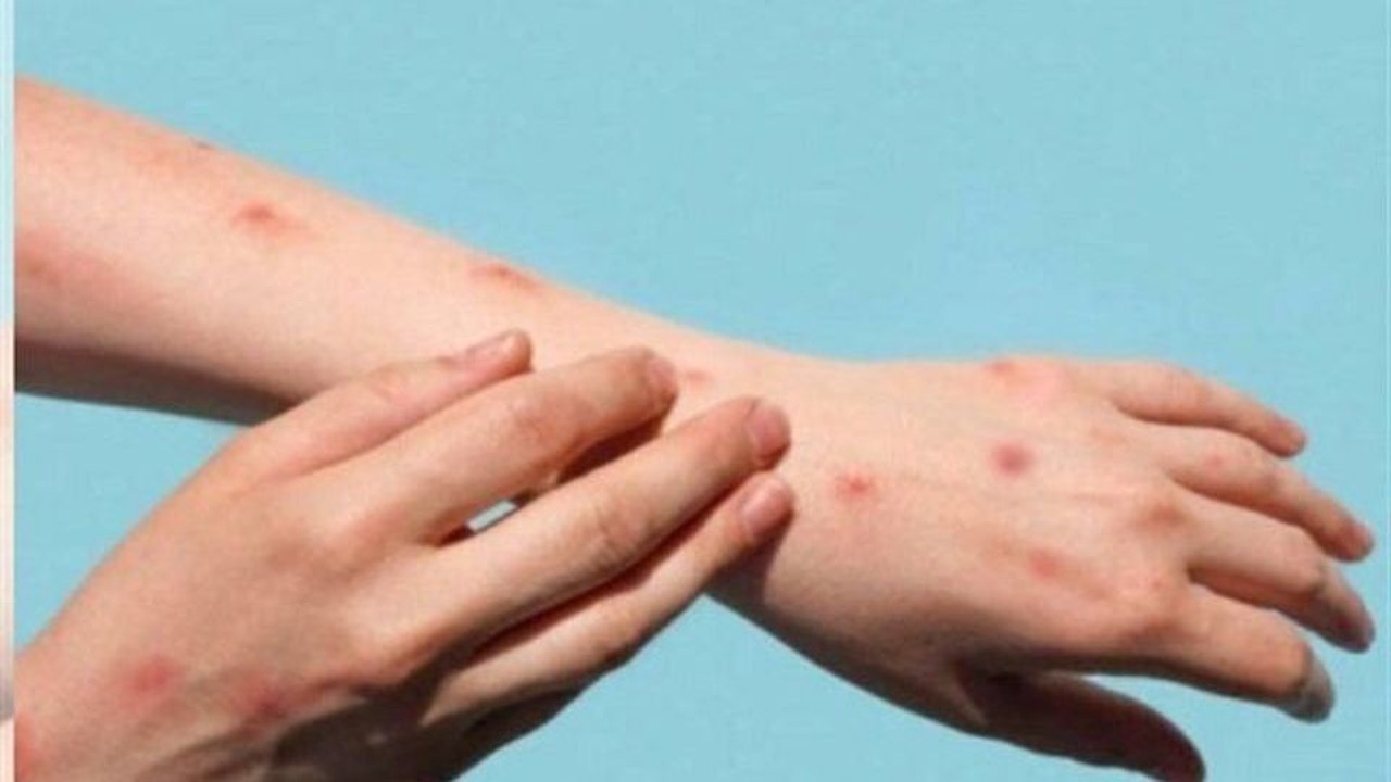 ایمنی به آبله‌مرغان دلیل ایمنی در مقابل آبله میمونی نیست / سمنان در آماده‌باش