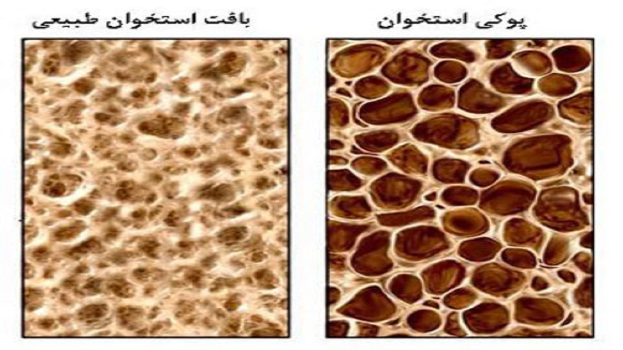 مراقبت از استخوان عامل پیشگیری از پوکی استخوان