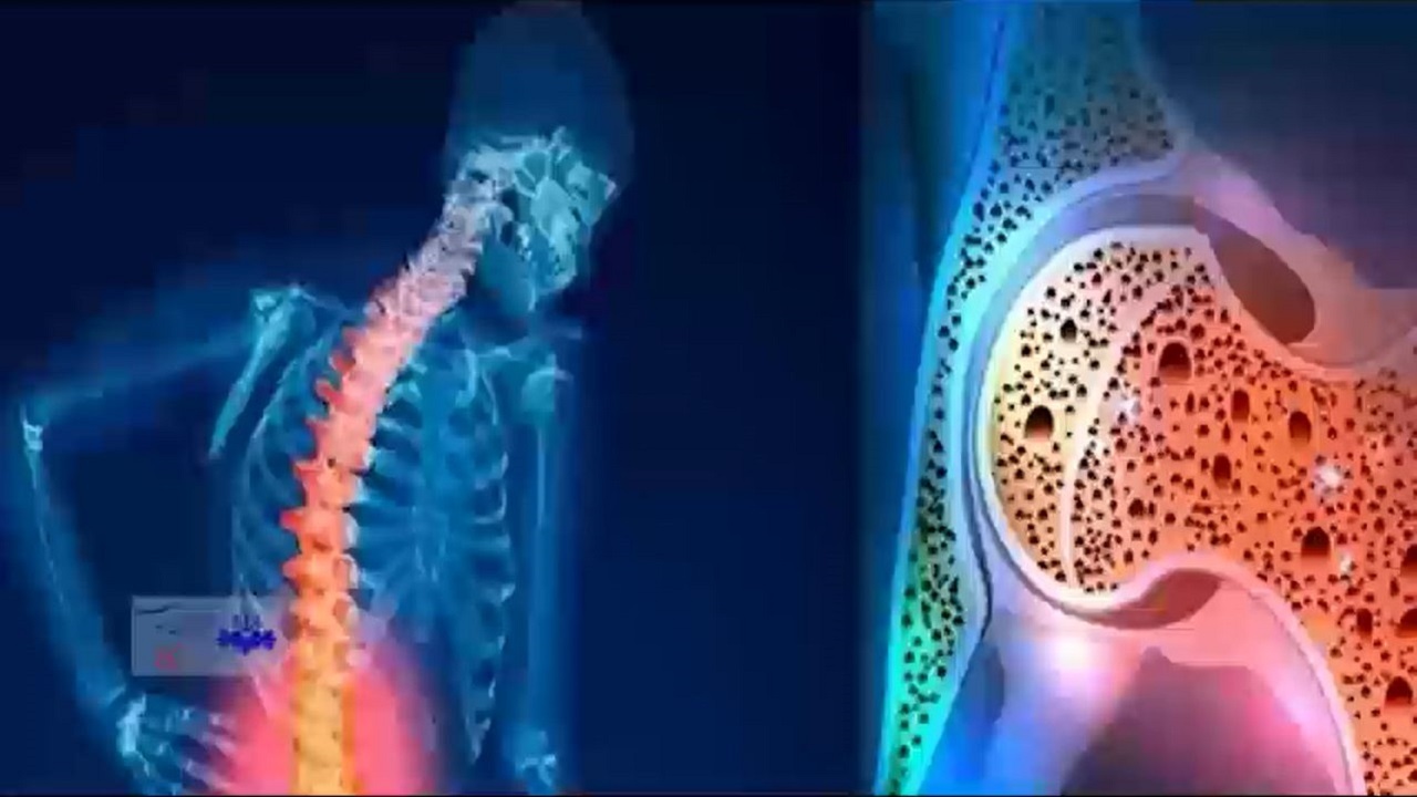 اصلاح عادت‌ غذایی برای پیشگیری از پوکی استخوان + فیلم