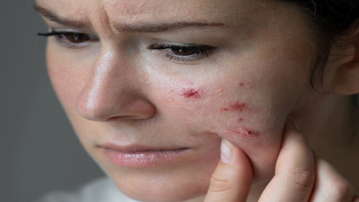 باشگاه خبرنگاران -جوش‌های صورت چگونه زندگی را تهدید می‌کنند؟