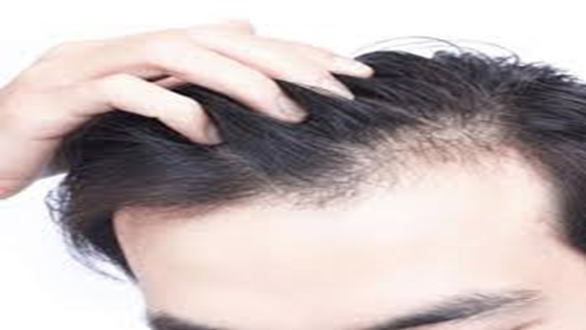 شرایط کاشت مو چیست؟
