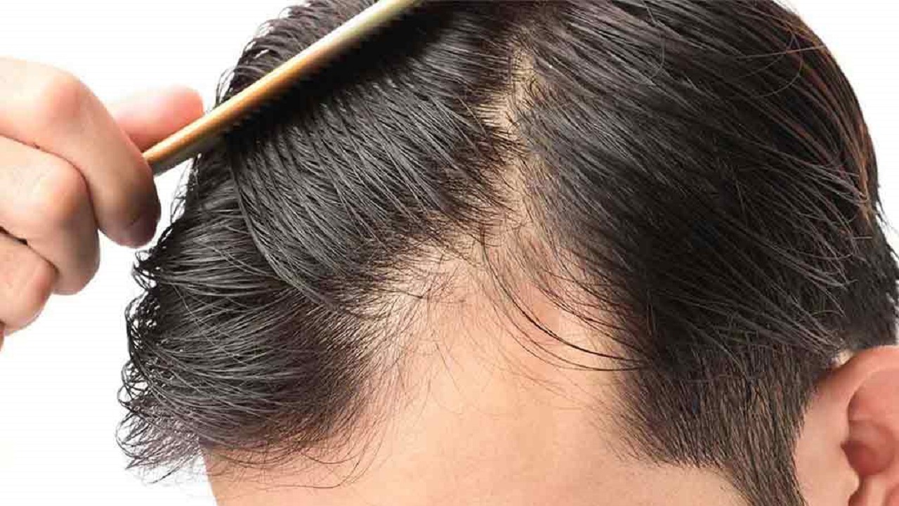 ارتباط اختلالات روانشناختی و ریزش مو