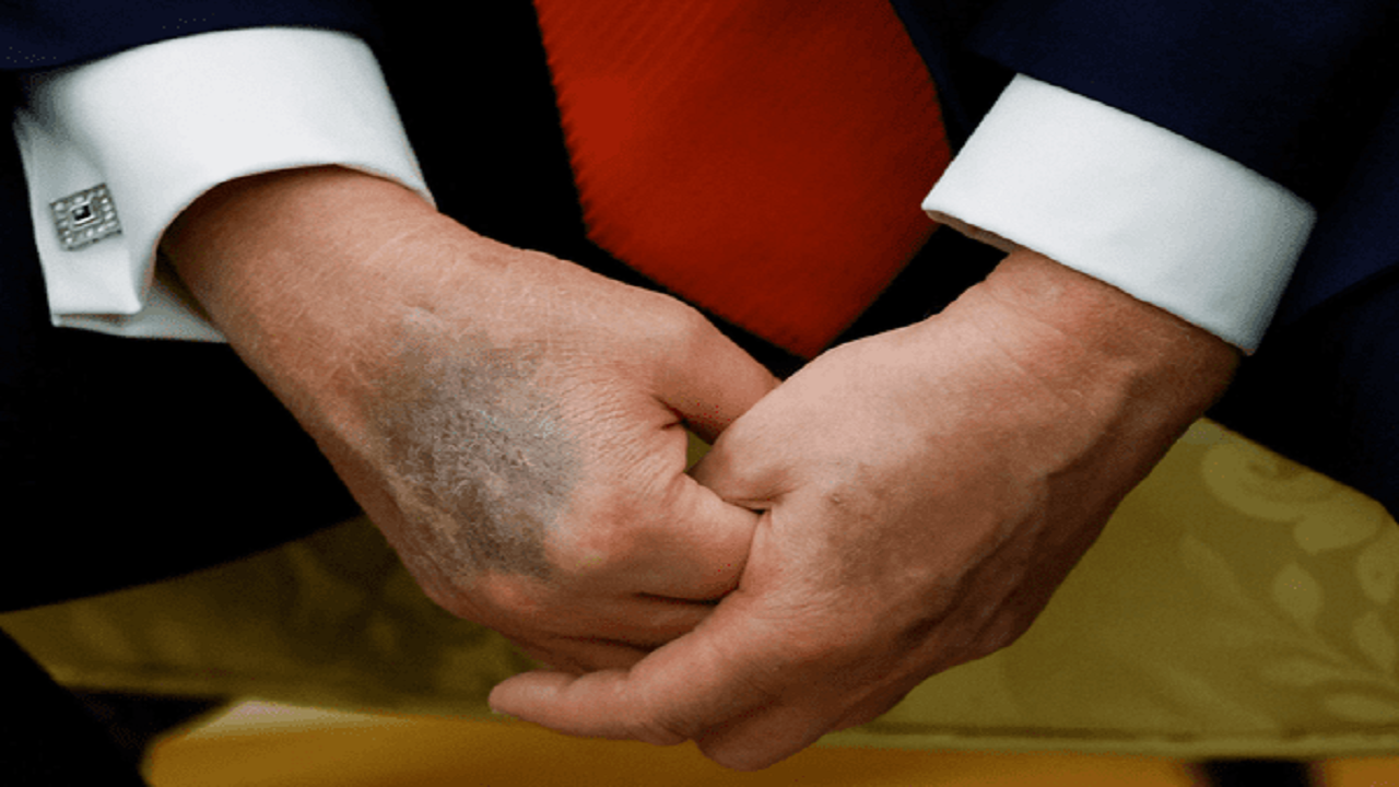 کبودی دست ترامپ باز هم سوژه رسانه‌ها شد