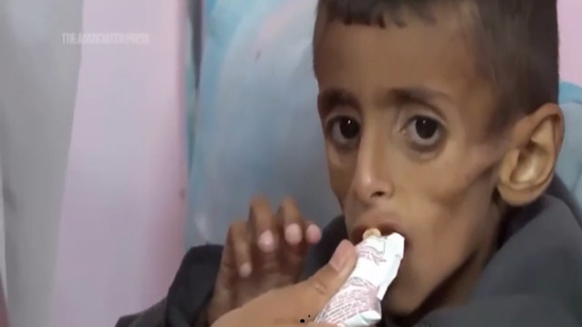 نوزاد اهل غزه به‌دلیل گرما دچار تاول و بیماری پوستی دردناک شد + فیلم