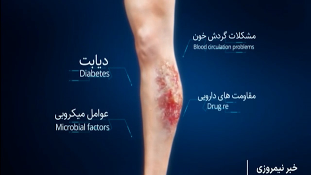 توسعه فناوری پلاسمای سرد برای درمان زخم‌های دیابتی و مزمن + فیلم