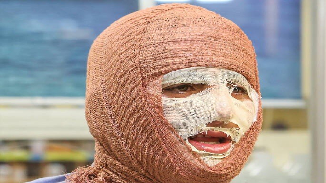 سوختگی؛ آسیب جسمی و روانی که فراتر از درمان است