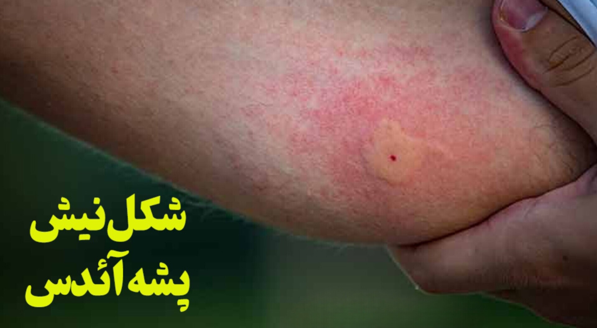 کرمان در آستانه تهدید زیستی؛ پشه آئدس در جیرفت مشاهده شد کرمان در آستانه تهدید زیستی؛ پشه آئدس در جیرفت مشاهده شد