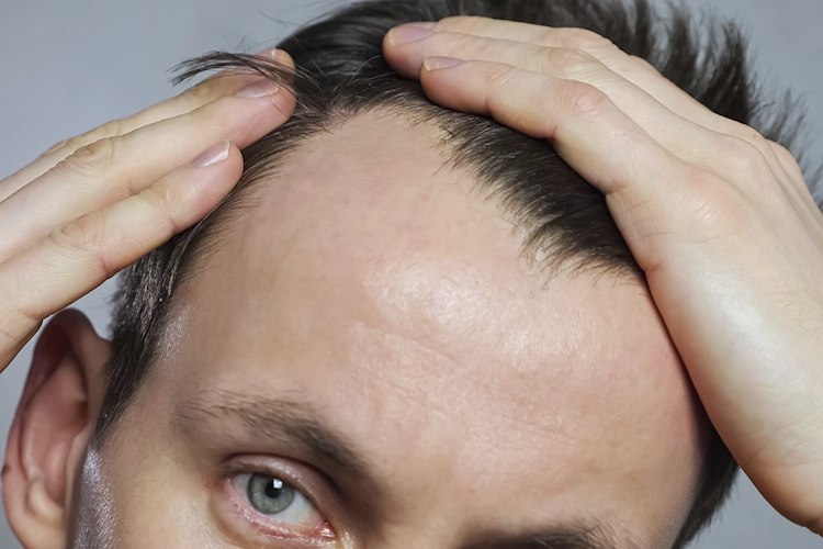 آیا مکمل کراتین باعث ریزش مو می&zwnj;شود؟